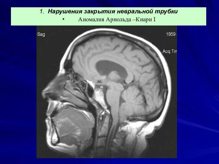 1. Нарушения закрытия невральной трубки Аномалия Арнольда –Киари I