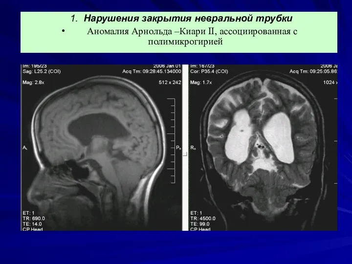 1. Нарушения закрытия невральной трубки Аномалия Арнольда –Киари II, ассоциированная с полимикрогирией