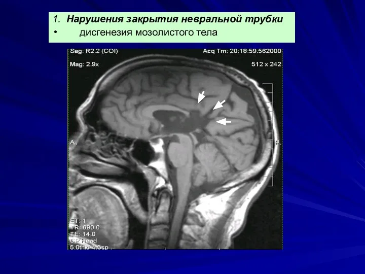 1. Нарушения закрытия невральной трубки дисгенезия мозолистого тела