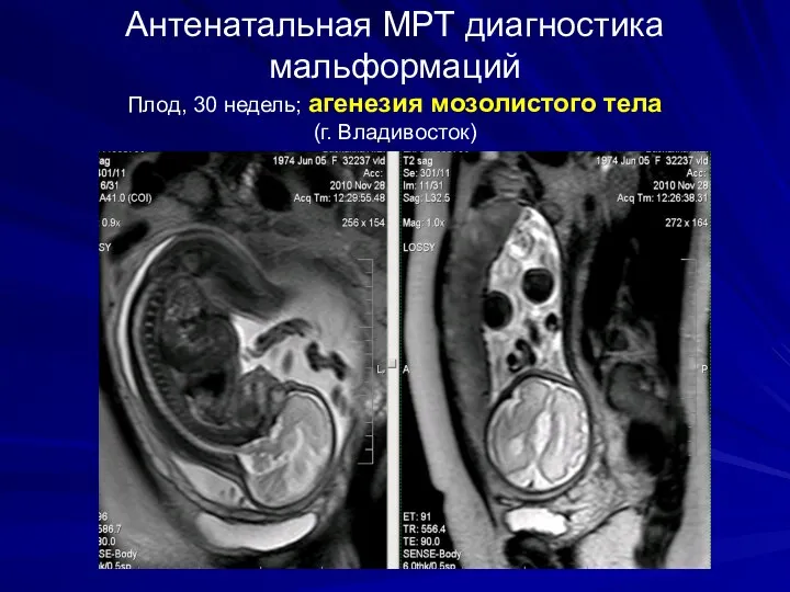 Антенатальная МРТ диагностика мальформаций Плод, 30 недель; агенезия мозолистого тела (г. Владивосток)