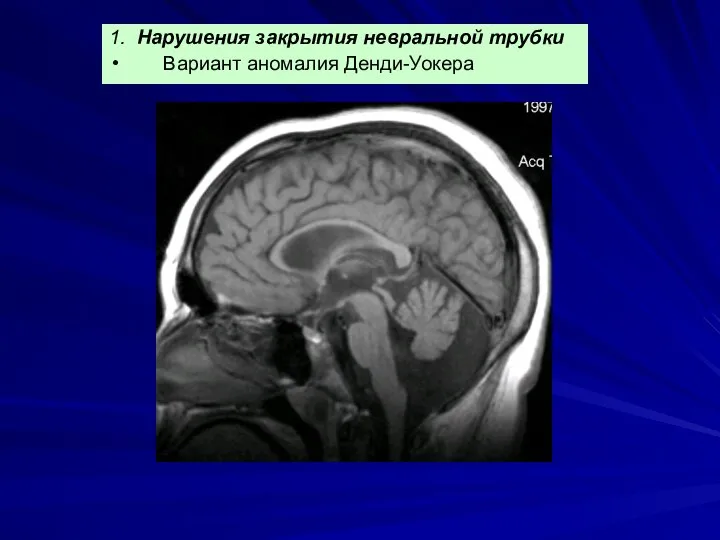 1. Нарушения закрытия невральной трубки Вариант аномалия Денди-Уокера