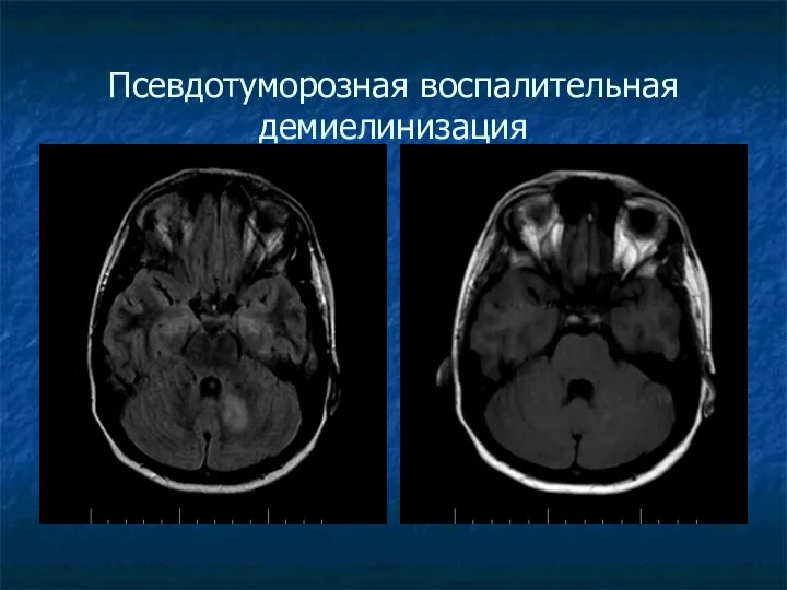 Псевдотуморозная воспалительная демиелинизация