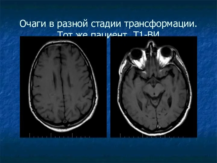 Очаги в разной стадии трансформации. Тот же пациент. Т1-ВИ