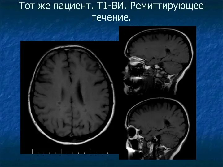 Тот же пациент. Т1-ВИ. Ремиттирующее течение.