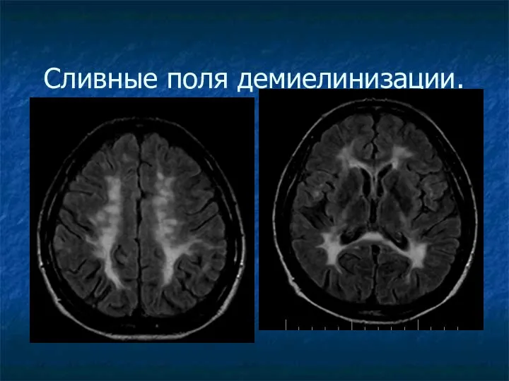 Сливные поля демиелинизации.