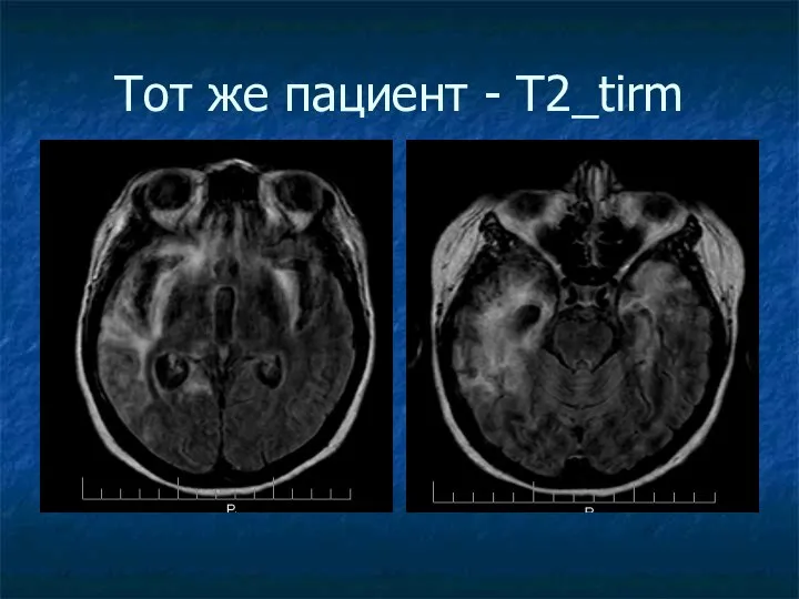 Тот же пациент - Т2_tirm