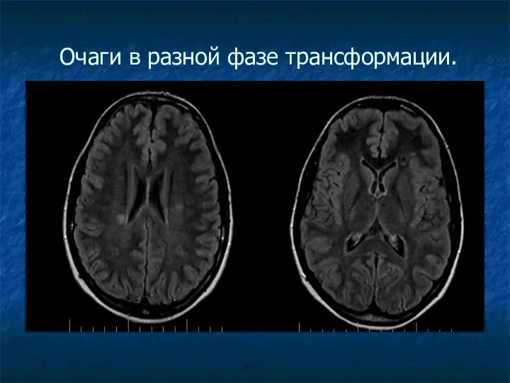 Очаги в разной фазе трансформации.