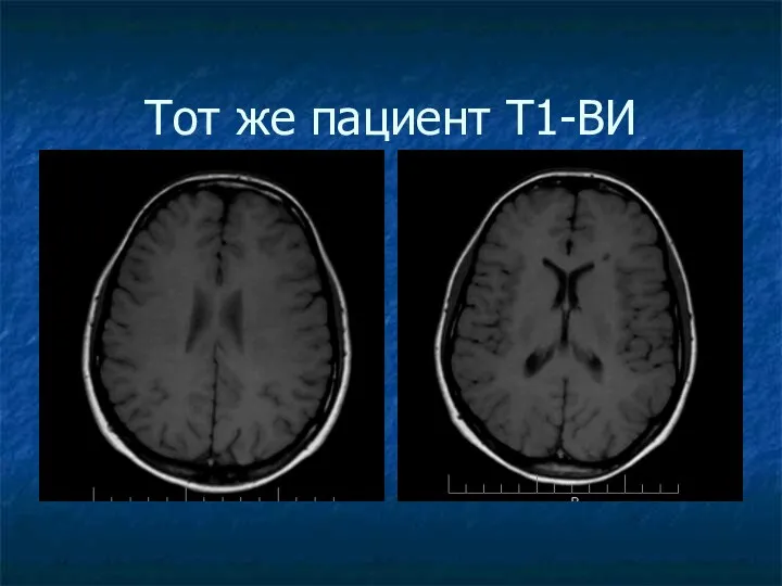 Тот же пациент Т1-ВИ