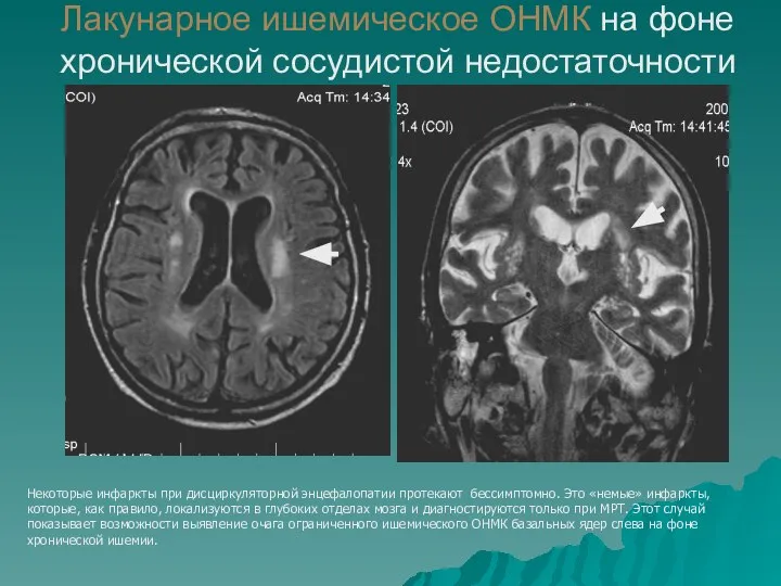 Лакунарное ишемическое ОНМК на фоне хронической сосудистой недостаточности Некоторые инфаркты при