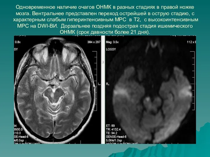 Одновременное наличие очагов ОНМК в разных стадиях в правой ножке мозга.