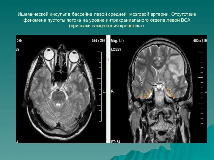 Ишемической инсульт в бассейне левой средней мозговой артерии. Отсутствие феномена пустоты