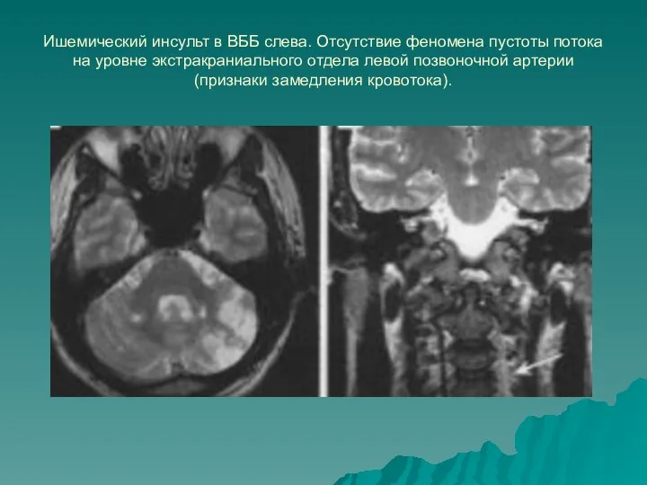 Ишемический инсульт в ВББ слева. Отсутствие феномена пустоты потока на уровне