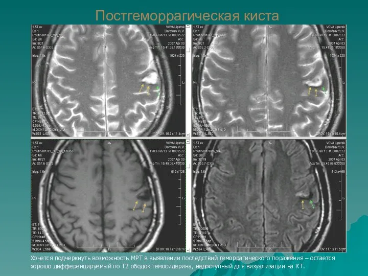 Постгеморрагическая киста Хочется подчеркнуть возможность МРТ в выявлении последствий геморрагического поражения