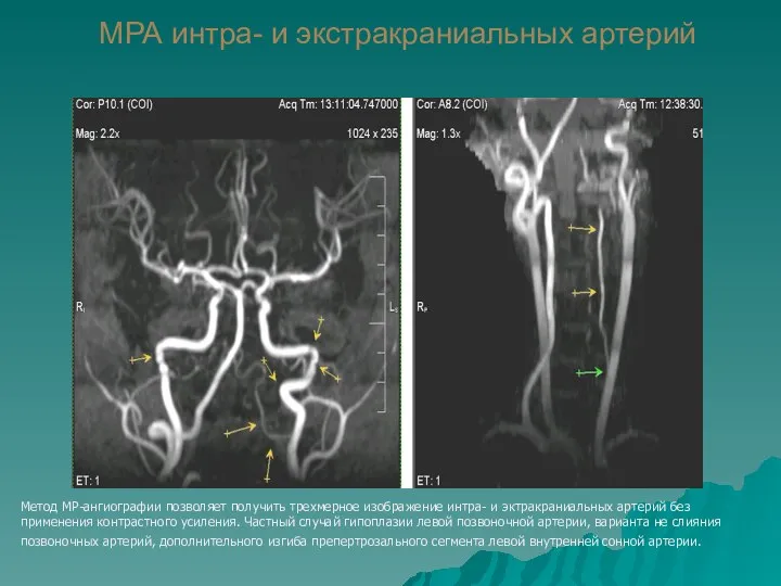 МРА интра- и экстракраниальных артерий Метод МР-ангиографии позволяет получить трехмерное изображение