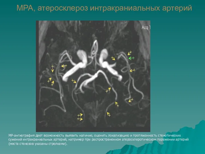 МРА, атеросклероз интракраниальных артерий МР-ангиография дает возможность выявить наличие, оценить локализацию