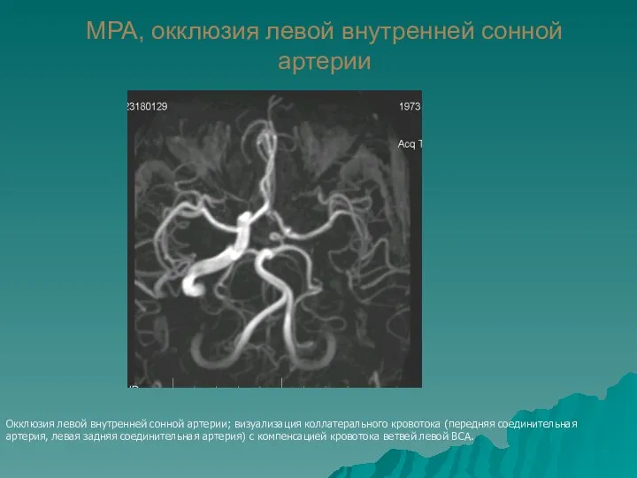 МРА, окклюзия левой внутренней сонной артерии Окклюзия левой внутренней сонной артерии;