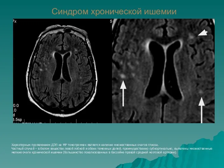 Синдром хронической ишемии Характерным проявлением ДЭП на МР томограммах является наличие