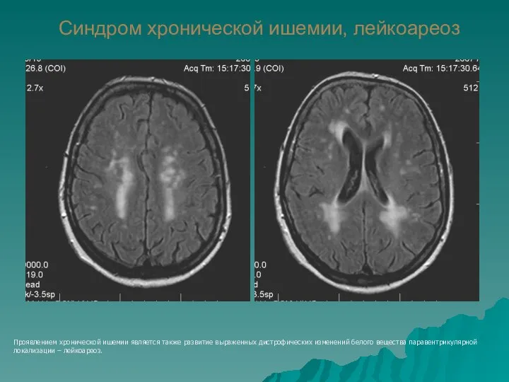 Синдром хронической ишемии, лейкоареоз Проявлением хронической ишемии является также развитие выраженных