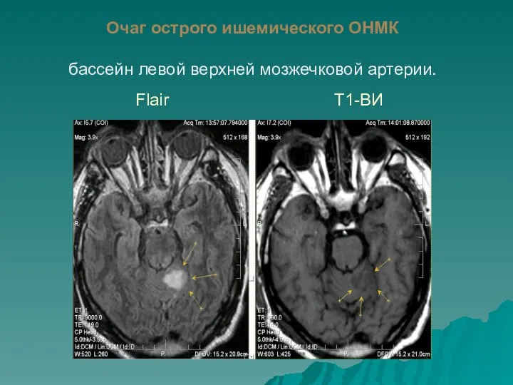 Очаг острого ишемического ОНМК бассейн левой верхней мозжечковой артерии. Flair Т1-ВИ