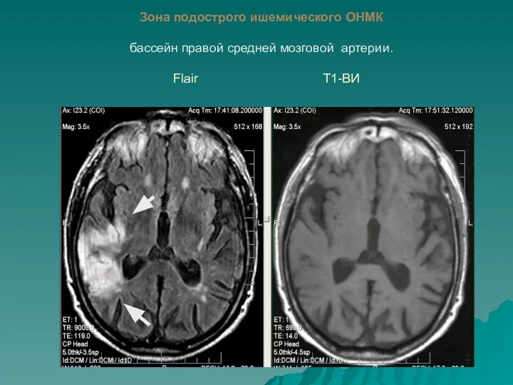 Зона подострого ишемического ОНМК бассейн правой средней мозговой артерии. Flair Т1-ВИ