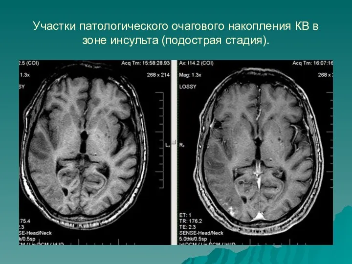 Участки патологического очагового накопления КВ в зоне инсульта (подострая стадия).