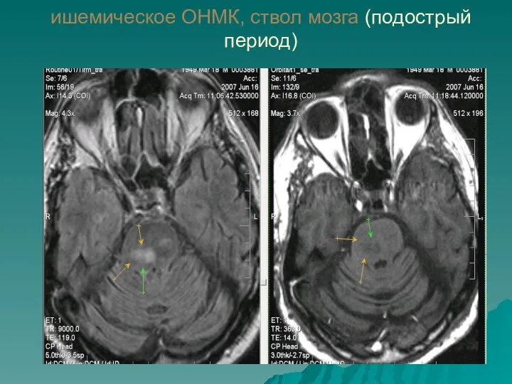 ишемическое ОНМК, ствол мозга (подострый период)