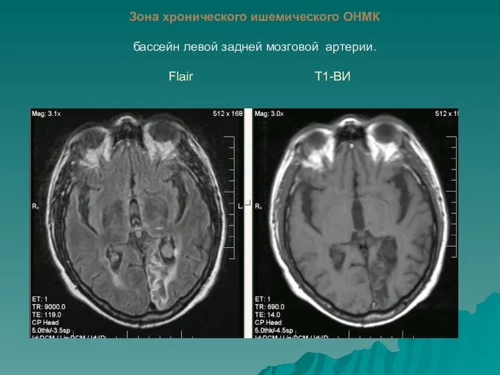 Зона хронического ишемического ОНМК бассейн левой задней мозговой артерии. Flair Т1-ВИ