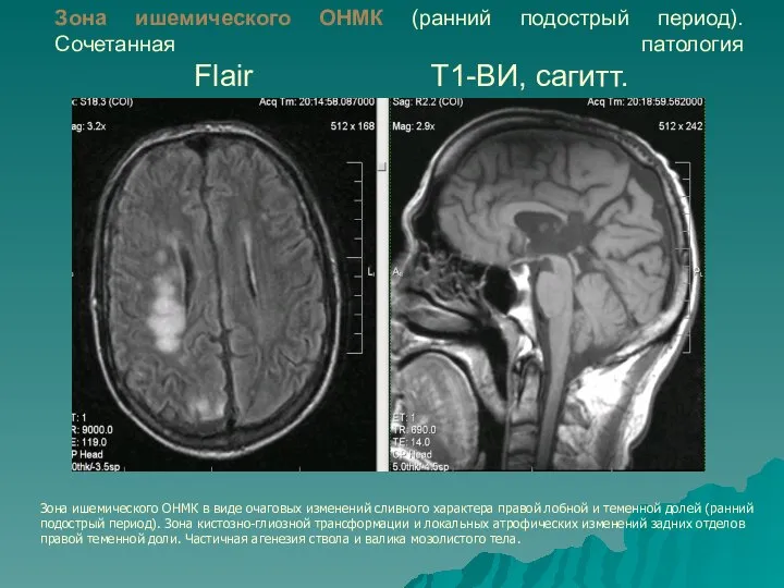 Зона ишемического ОНМК (ранний подострый период). Сочетанная патология Flair Т1-ВИ, сагитт.