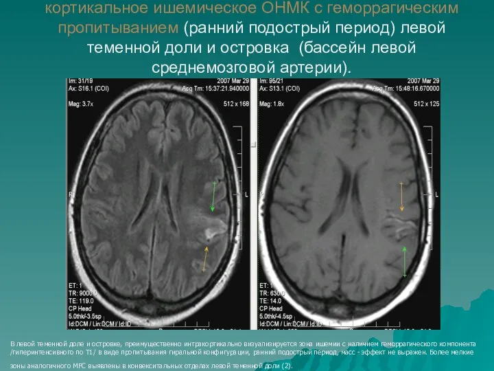 кортикальное ишемическое ОНМК с геморрагическим пропитыванием (ранний подострый период) левой теменной