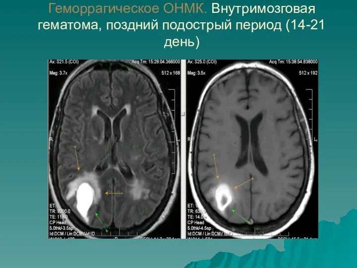 Геморрагическое ОНМК. Внутримозговая гематома, поздний подострый период (14-21 день)