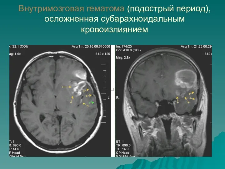 Внутримозговая гематома (подострый период), осложненная субарахноидальным кровоизлиянием