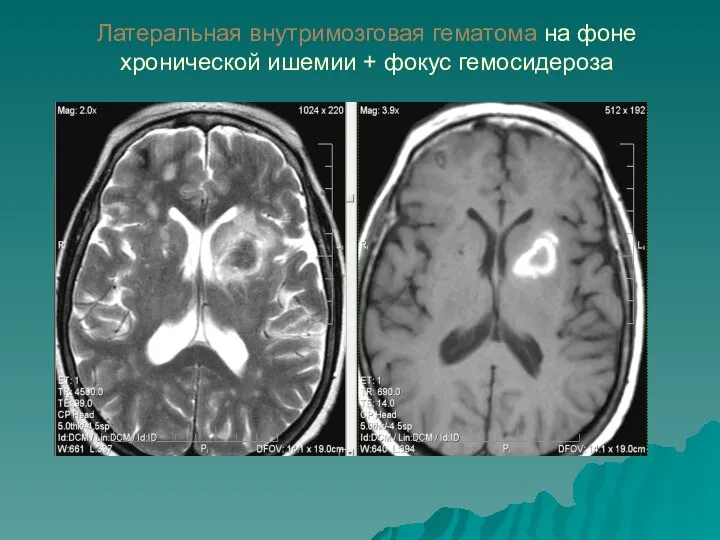 Латеральная внутримозговая гематома на фоне хронической ишемии + фокус гемосидероза