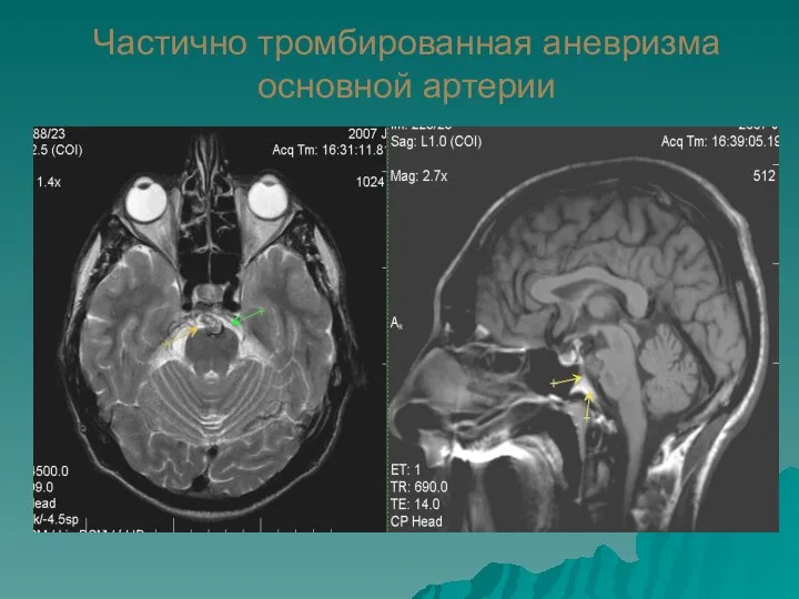 Частично тромбированная аневризма основной артерии