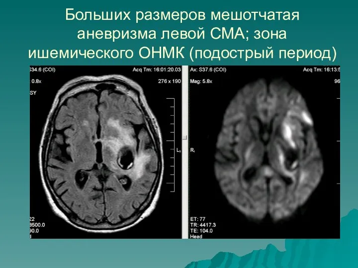 Больших размеров мешотчатая аневризма левой СМА; зона ишемического ОНМК (подострый период)