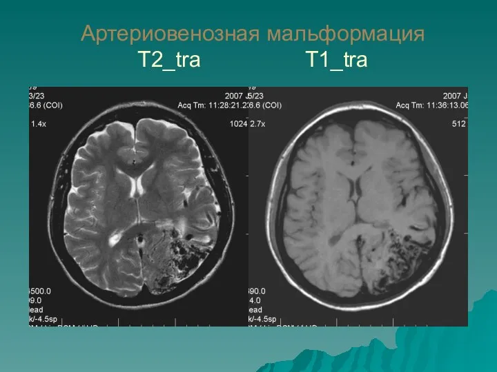 Артериовенозная мальформация T2_tra T1_tra