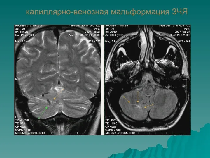 капиллярно-венозная мальформация ЗЧЯ