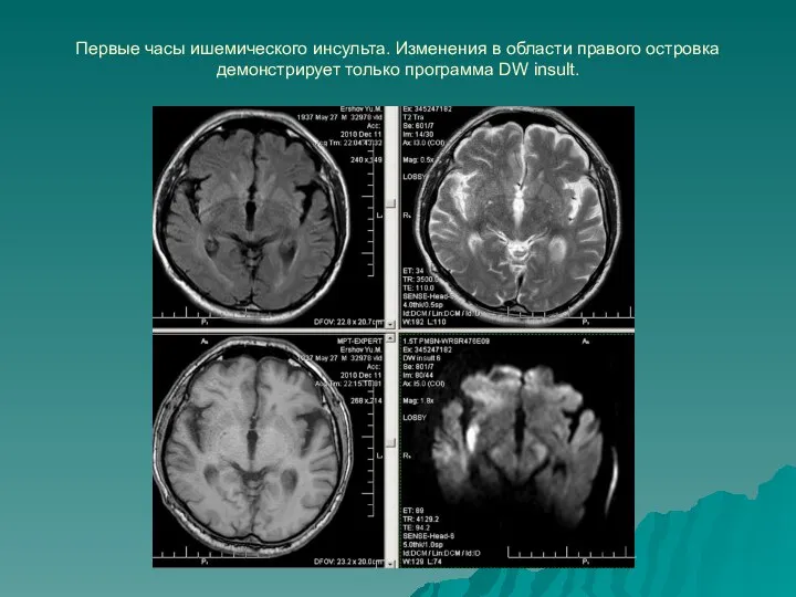 Первые часы ишемического инсульта. Изменения в области правого островка демонстрирует только программа DW insult.