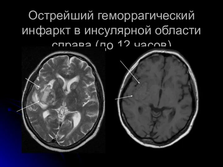 Острейший геморрагический инфаркт в инсулярной области справа (до 12 часов)