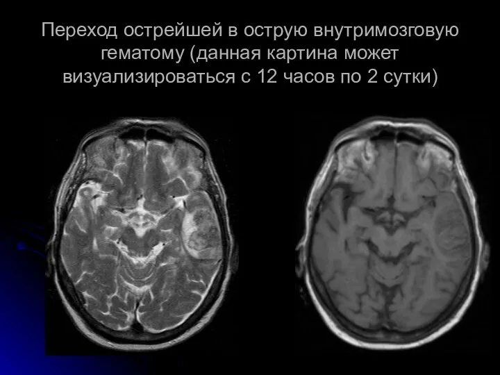 Переход острейшей в острую внутримозговую гематому (данная картина может визуализироваться с 12 часов по 2 сутки)