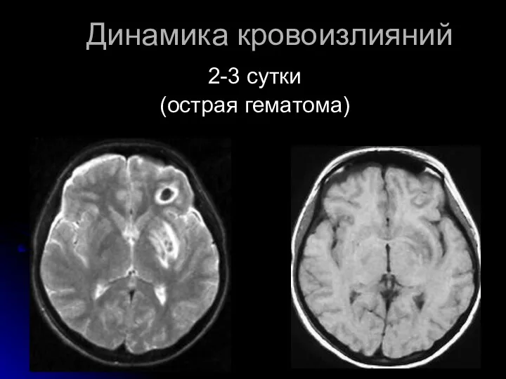 Динамика кровоизлияний 2-3 сутки (острая гематома)