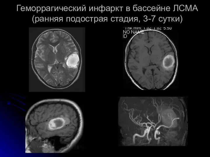 Геморрагический инфаркт в бассейне ЛСМА (ранняя подострая стадия, 3-7 сутки)