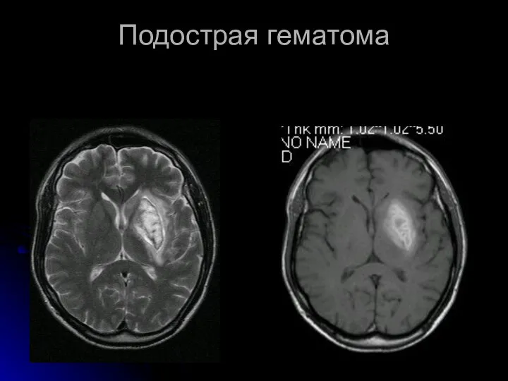 Подострая гематома