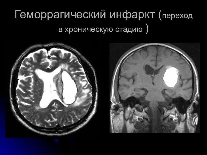 Геморрагический инфаркт (переход в хроническую стадию )