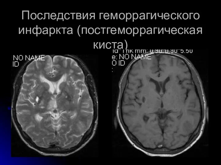 Последствия геморрагического инфаркта (постгеморрагическая киста)