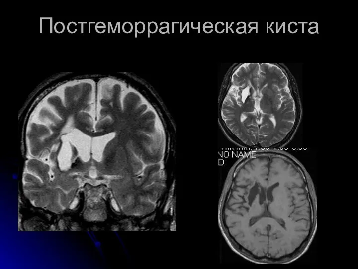 Постгеморрагическая киста