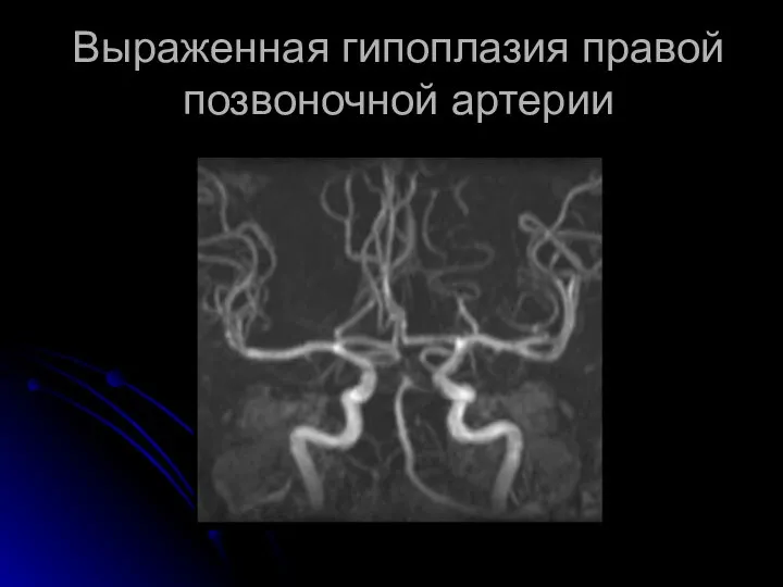 Выраженная гипоплазия правой позвоночной артерии