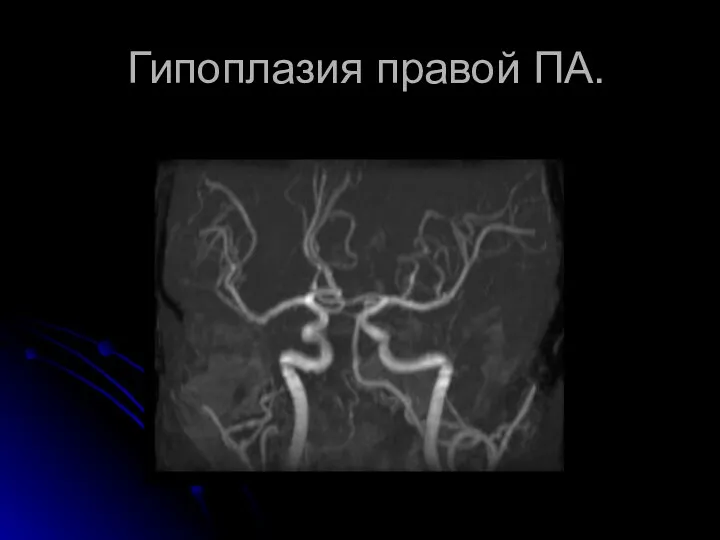 Гипоплазия правой ПА.