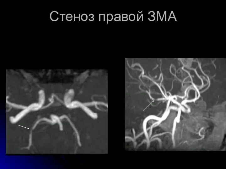 Стеноз правой ЗМА