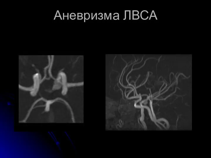 Аневризма ЛВСА