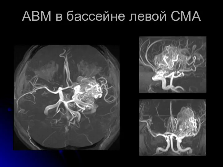 АВМ в бассейне левой СМА